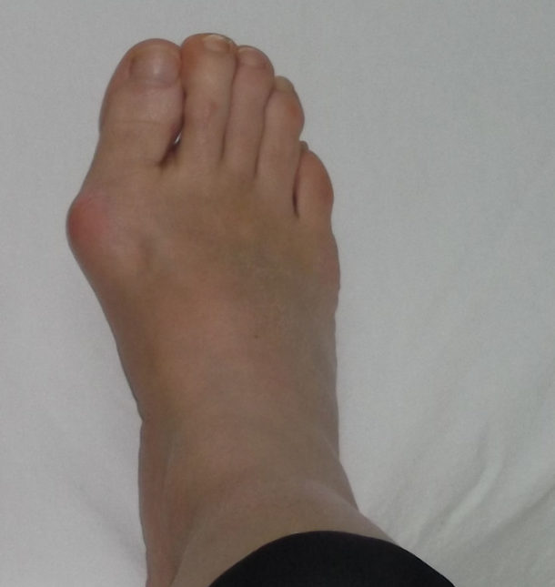 NonSurgical Bunion Treatment Innovative Therapy Canada