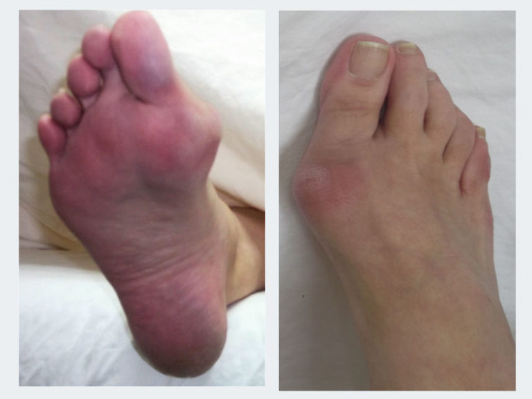 NonSurgical Bunion Treatment Innovative Therapy Canada