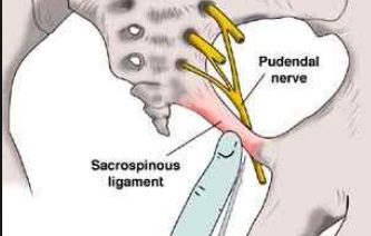 Pudendal Nerve Entrapment relief 