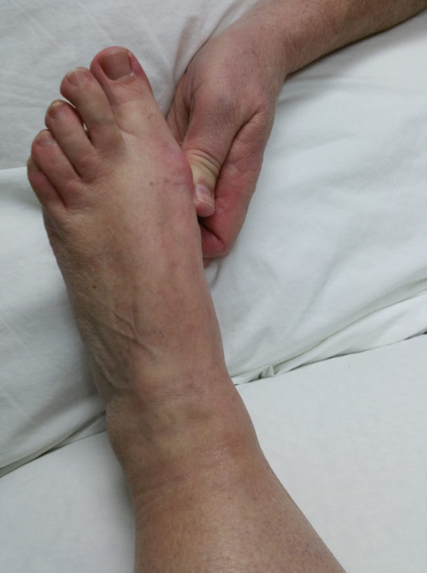 NonSurgical Bunion Treatment Innovative Therapy Canada