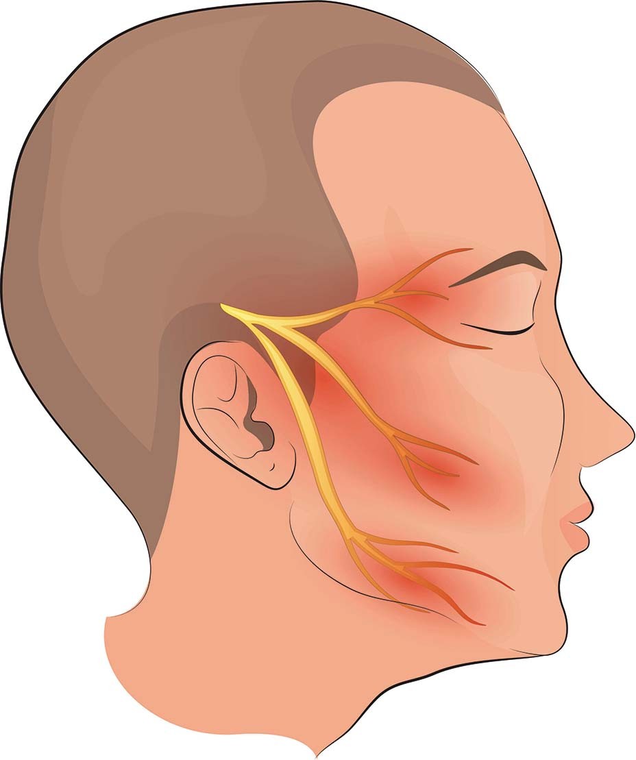 Trigeminal Neuralgia – Burning Mouth Syndrome