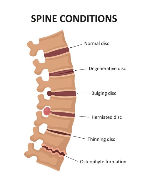 Innovative Therapy Canada Degenerative Disk Disease