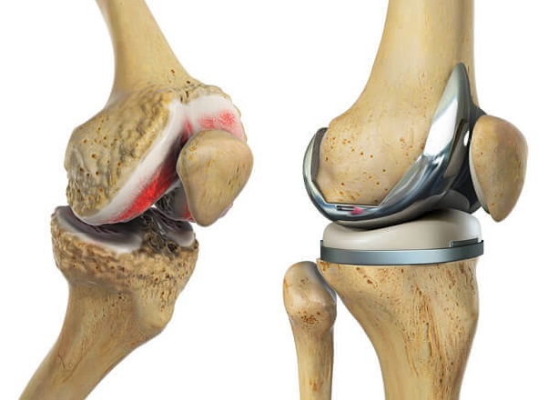 Post Surgery Pain Therapy Innovative Therapy Canada Post Surgery Pain Therapy Innovative Therapy Canada