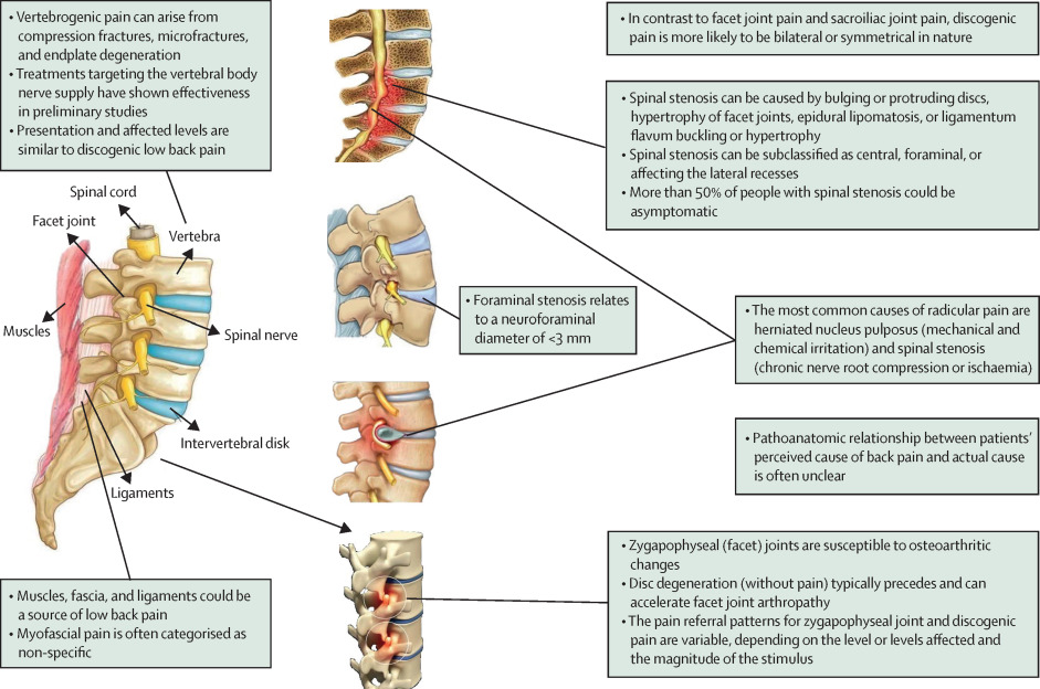 Chronic Back Pain Treatment Innovative Therapy Canada 