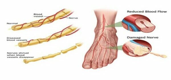 Innovative Therapy Canada Peripheral Neuropathy