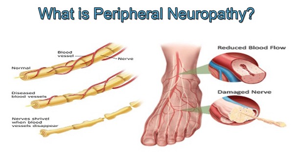 Innovative_Therapy_Canada_Peripheral_Neuropathy