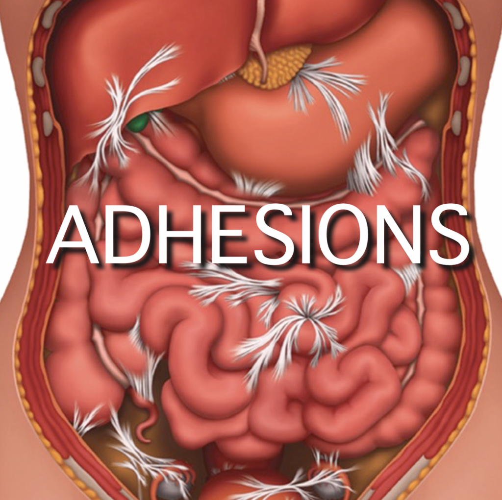 Abdominal Adhesions Due To Surgery Innovative Therapy Canada