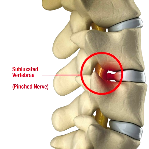 Pinched Nerve Innovative Therapy Canada