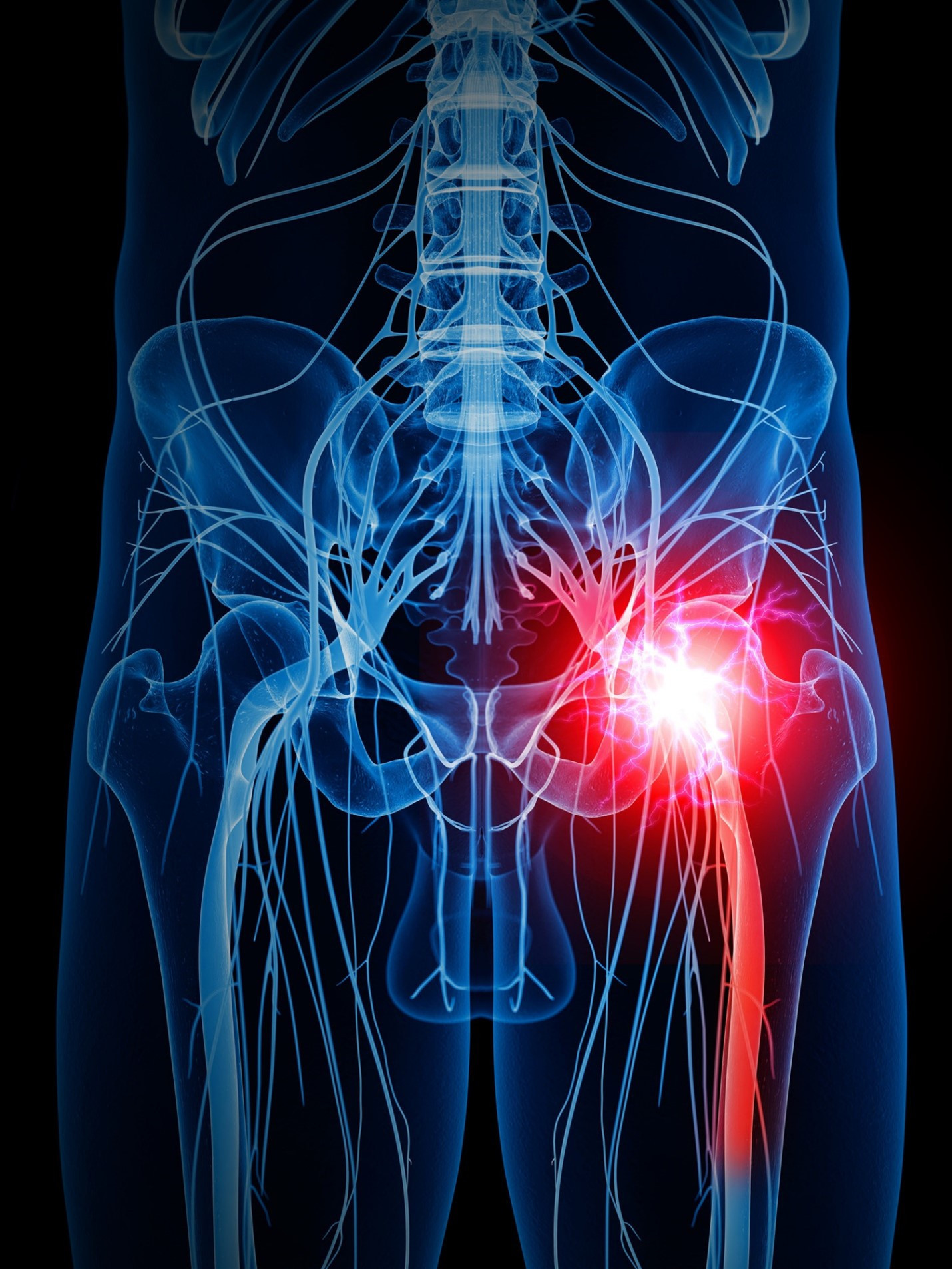 Sciatica Chronic Pain Innovative Therapy Canada